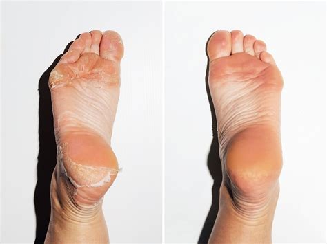  Exploring Various Explanations for Dreams Involving Peelable Foot Skin 