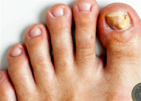  Exploring the Psychological Factors Associated with Dreaming about Deteriorating Toenails 