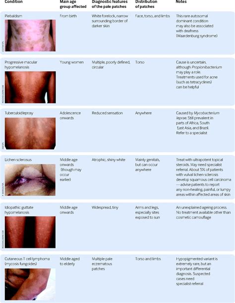  Medical Conditions Associated with Hypopigmentation on the Epidermis 