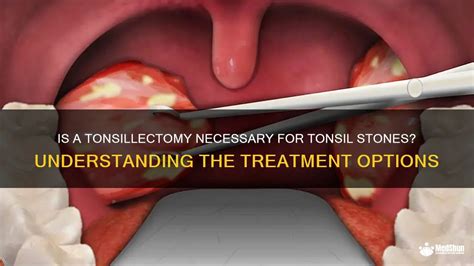  Medical Treatments for Tonsil Stones: Removal and Prevention Options 