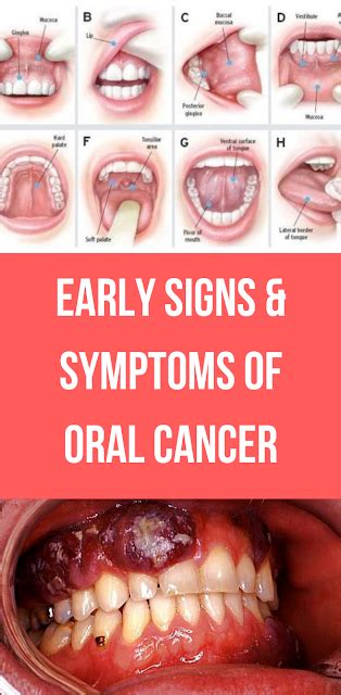  Recognizing the Early Signs and Symptoms of Oral Neoplasms