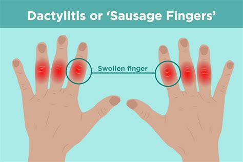  Thumb Swelling: Common Causes and Symptoms
