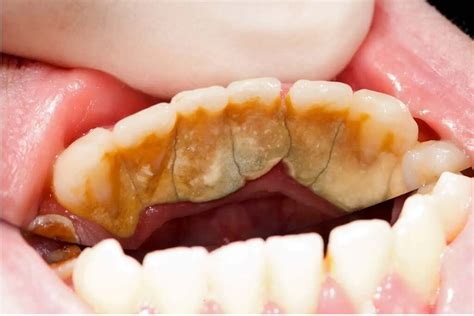  Understanding Dental Plaque and Tartar Buildup
