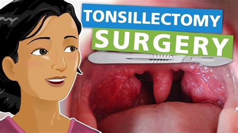  Weighing the Pros and Cons of Surgical Tonsil Removal 