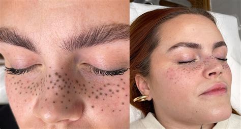 A Snapshot of the Trend: Rise in Facial Ink