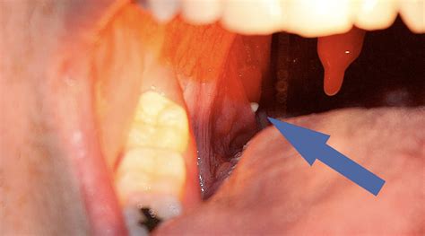 About the Removal of Tonsils: An Extensive Overview