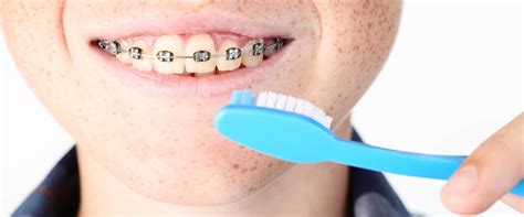 Achieving a Flawless Smile: Key Tips to Maintain Oral Hygiene During Orthodontic Treatment