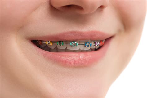 Achieving the Perfect Smile: Understanding the Significance of Orthodontic Braces