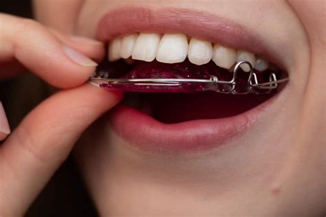 Addressing Oral Health Concerns Related to Wearing a Retainer