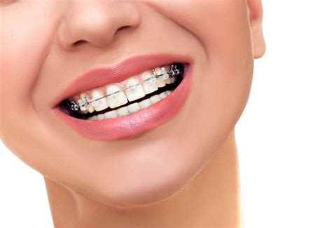 Adjusting to Wearing a Teeth Retainer: What to Expect