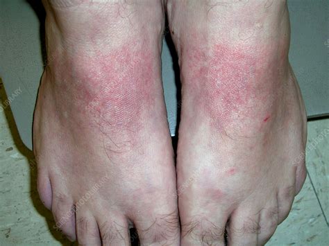 Allergic Contact Dermatitis: A Major Culprit