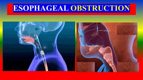 Analyzing Potential Causes of Throat Obstruction in Dreams