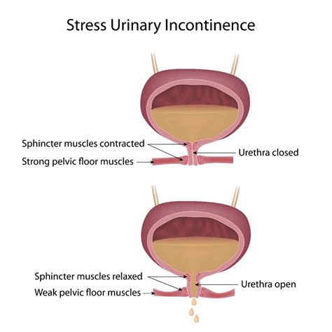 Analyzing the Role of Stress in Dreams Associated with Urinary Urgency