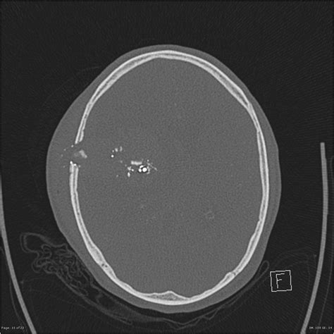 Are Dreams of Cranial Gunshot Wounds Linked to Real-Life Experiences?