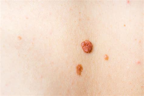 Are Skin Tags Dangerous? Debunking the Myths and Misconceptions