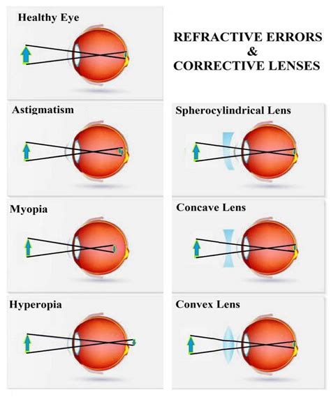 Avoiding Typical Errors When Utilizing Corrective Eye Lenses