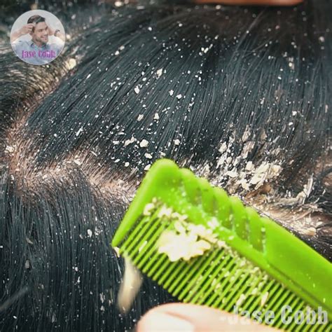 Banishing Severe Dandruff: Effective Solutions for a Healthy Scalp