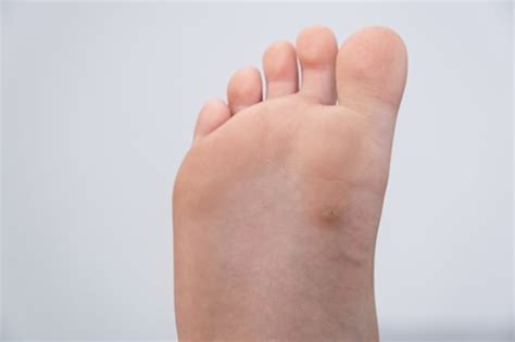 Banishing the Bumps: Effective Treatment Options for Foot Pimples