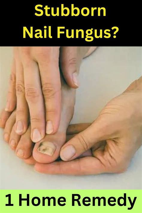 Banishing the Fungus: Top Treatment Options for Stubborn Toe Infections