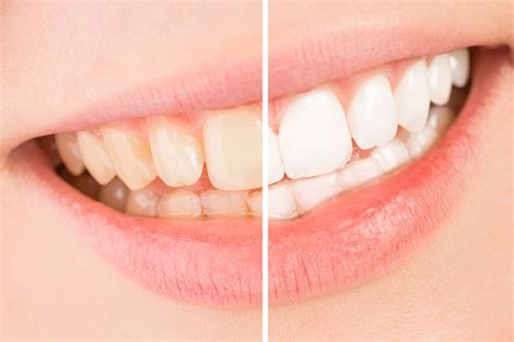 Benefits and Risks of Having Transparent Enamel