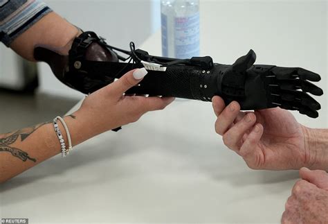 Beyond Physical Function: The Psychological Impact of Artificial Limbs