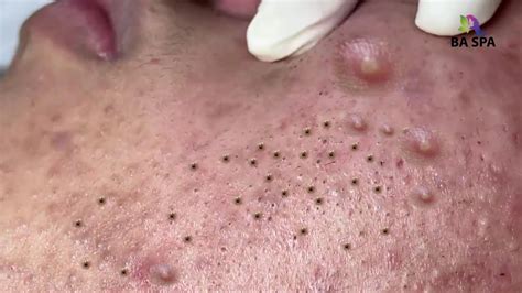 Blackhead-Popping Videos: A Social Media Phenomenon