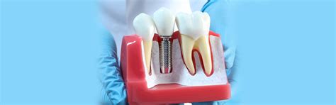 Boosting Confidence: The Advantages of Dental Implants