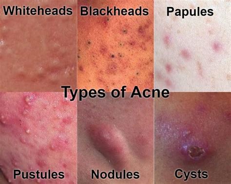 Can Dreams Regarding Acne on the Dorsal Area Signal a Disparity in Our Existence?