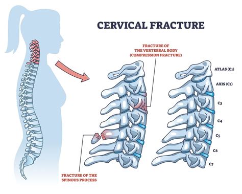 Can Dreams of Cervical Fractures Anticipate Future Occurrences?