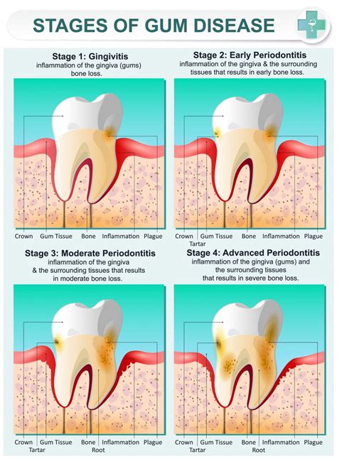 Cause of Loosening Gums: Understanding the Factors