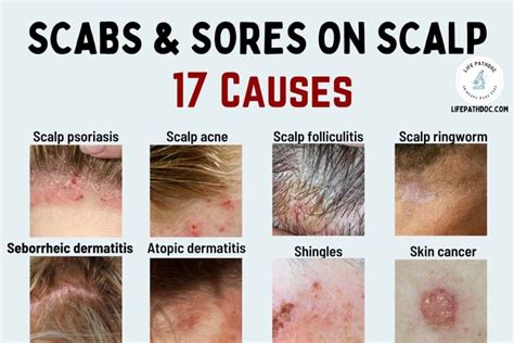 Causes and Solutions of Dreams Involving Scabs on the Scalp