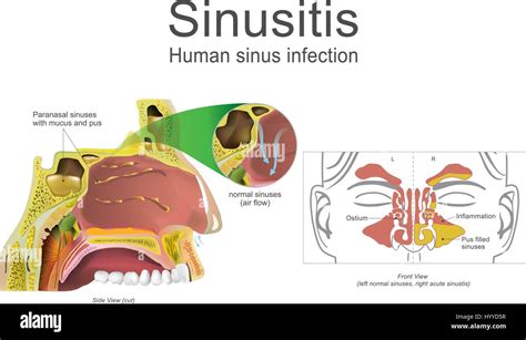 Causes and Types of Nasal Secretions in Dreams