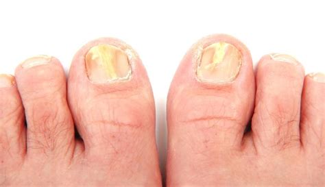 Causes of Dreams About Damaged Toenails