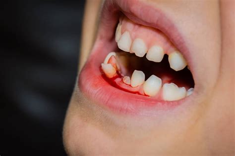 Childhood Memories: Understanding the Impact of Our Past on Dreaming about Loose Teeth