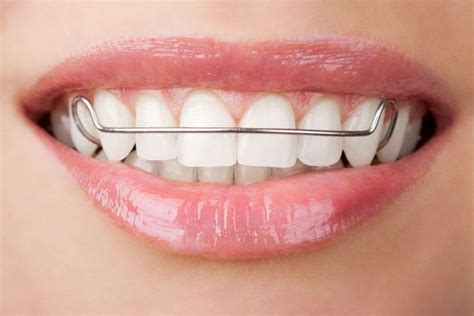 Choosing the Right Teeth Retainer for Your Needs