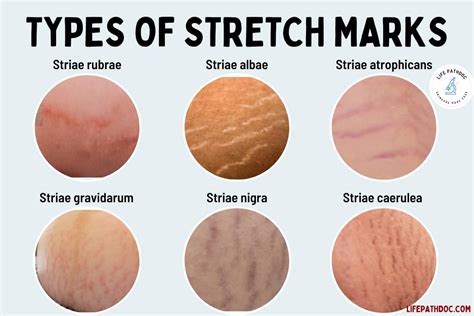 Common Factors Leading to the Formation of Stretch Marks in Real Life