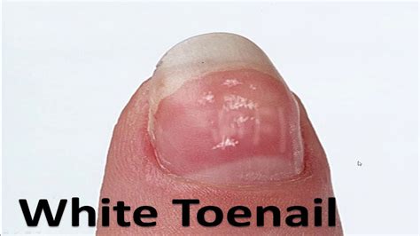 Common Nail Issues and Solutions: Troubleshooting Guide for Toenails