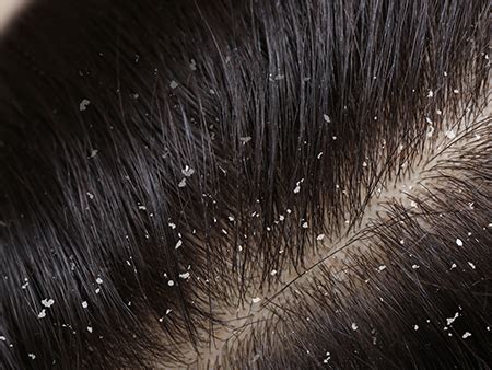 Common Signs and Consequences of Dandruff