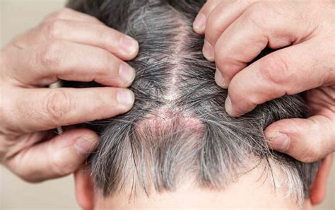 Common Skin Disorders Associated with Scalp Itchiness