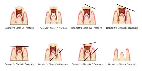 Common Themes and Patterns in Nightmares of Broken Dental Enamel