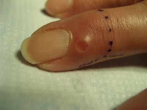 Common Triggers of Experiencing Pus-like Substance on One's Palm