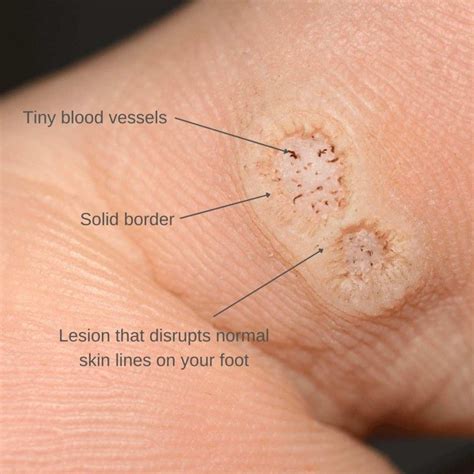 Common causes and risk factors for toe warts