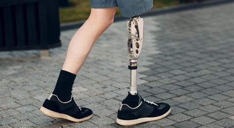 Conquering Obstacles in Adjusting to an Artificial Limb