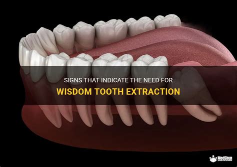 Considering the Physical Factors: Could Dreaming about Wisdom Teeth Extraction Indicate Dental Issues?