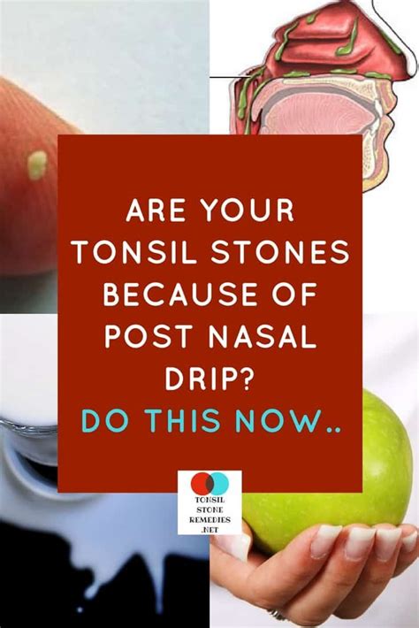 Contribution of Sinus Infections and Postnasal Drip to Formation of Tonsil Stones