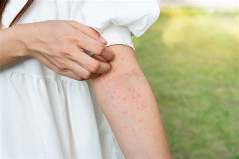 Coping Strategies to Relieve Dream Skin Rash Resulting from Stress