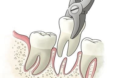 Coping strategies for managing repetitive dreams linked to tooth extraction experiences