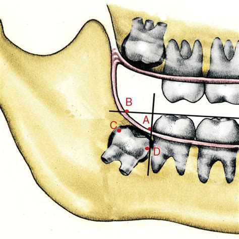 Cultural and Superstitious Beliefs Associated with Dreaming of Third Molar Eruption