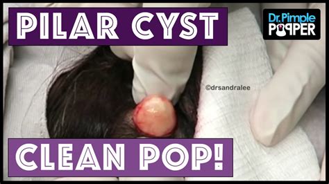 Cyst Popping as a Social Phenomenon: Community, Reaction, and Controversy