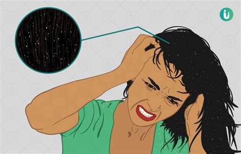 Dandruff Decoded: Understanding the Causes and Symptoms